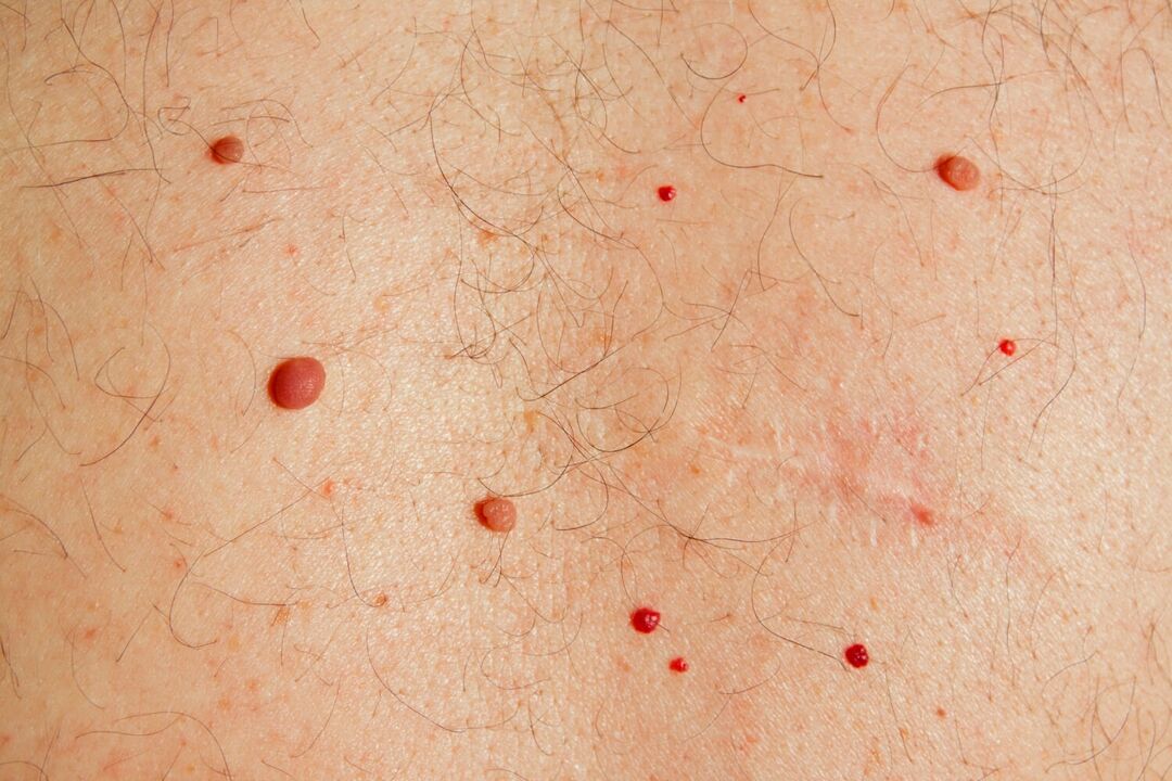 Papillomas caused by HPV in the body